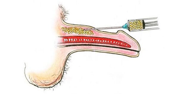 Injections d'acide hyaluronique dans le canon d'un membre pour l'augmenter